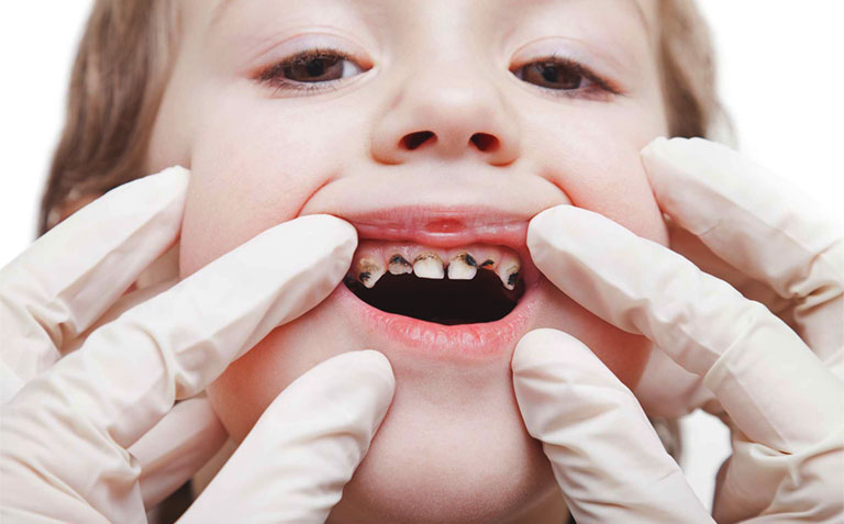 Hiểu rõ về sâu răng và thời gian nên đi khám